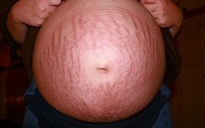 Estrias: Por que se formam? Como tratar?