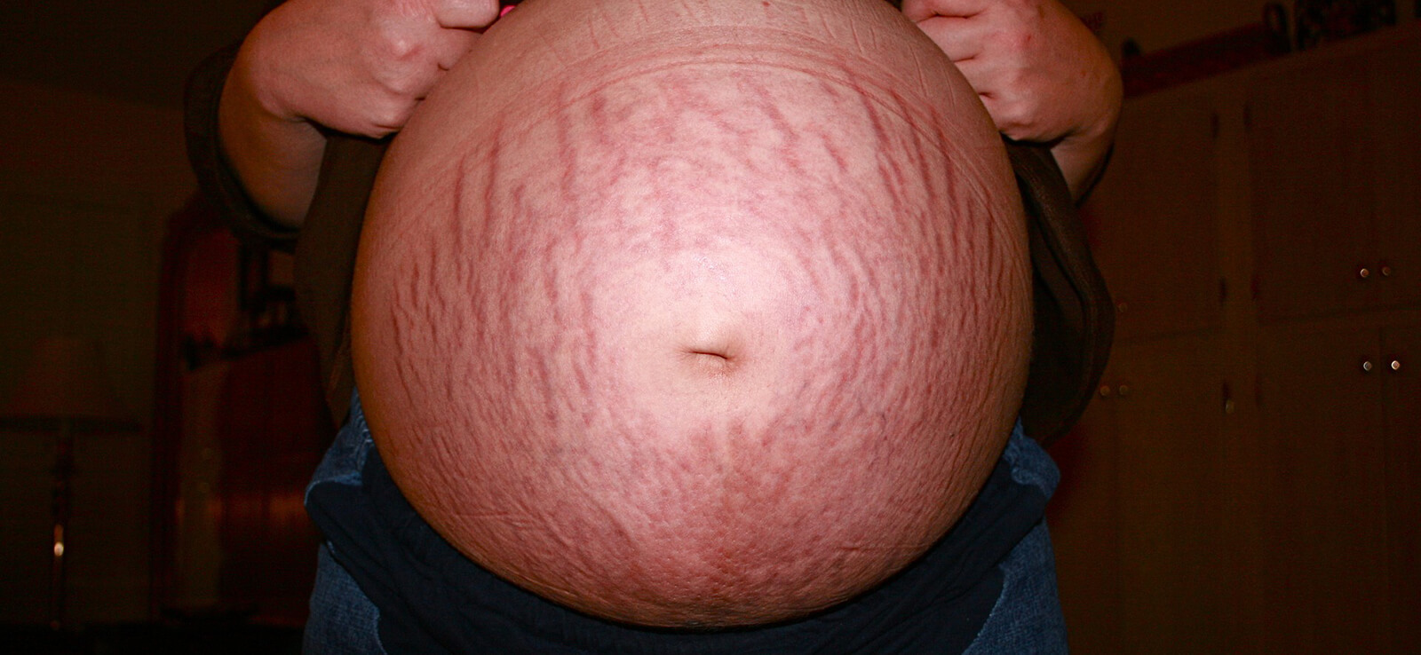 Estrias: Por que se formam? Como tratar?